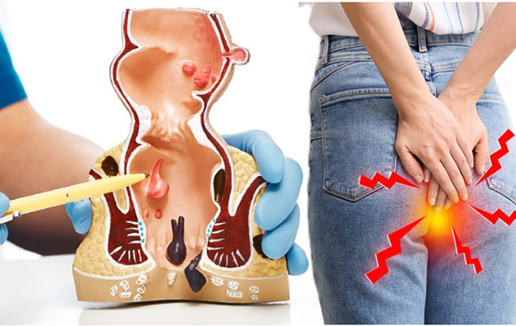 Bệnh trĩ là gì? triệu chứng, nguyên nhân, điều trị và cách phòng ngừa